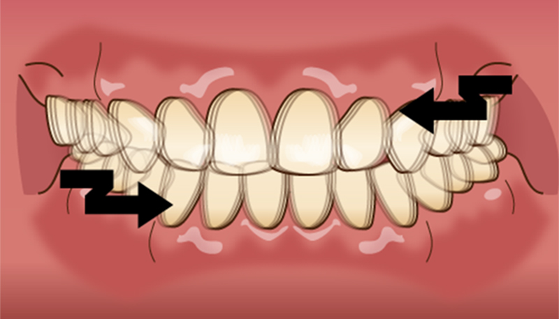 歯のこすり合わせ：グラインディングの症状は？